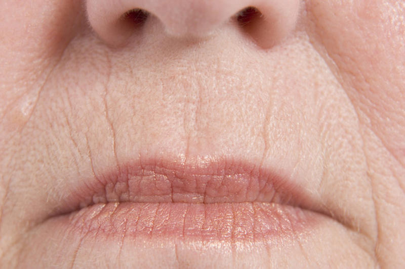 arrugas en la comisura de los labios